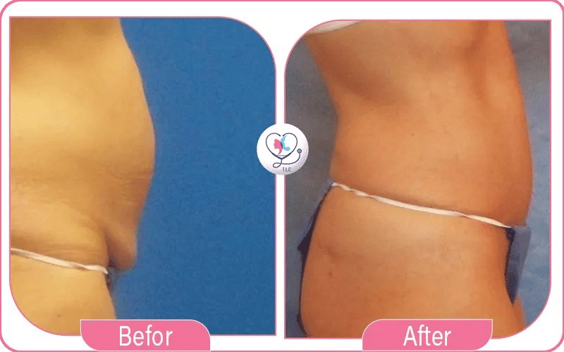 شفط الدهون بالفيزر قبل وبعد
