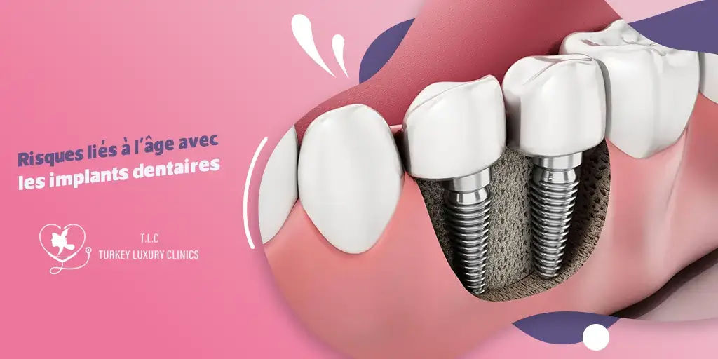 Risques liés à l'âge avec les implants dentaires