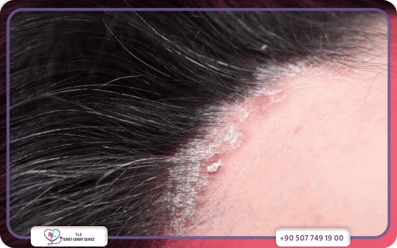 علاج صدفية الشعر بالأدوية والأجهزة