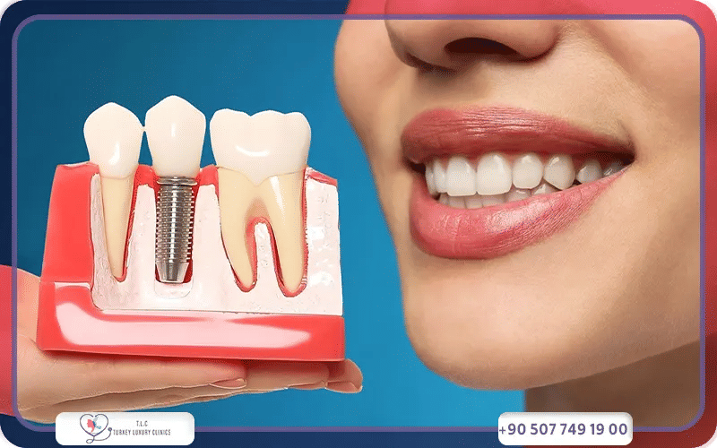 Comparaison international des tarifs implants dentaires