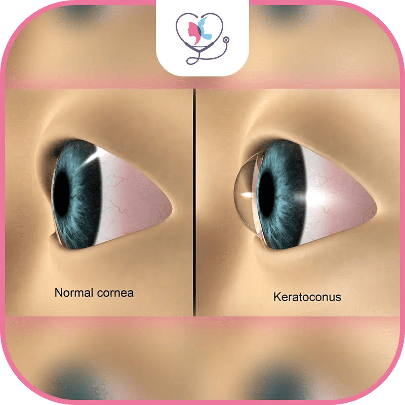 القرنية المخروطية