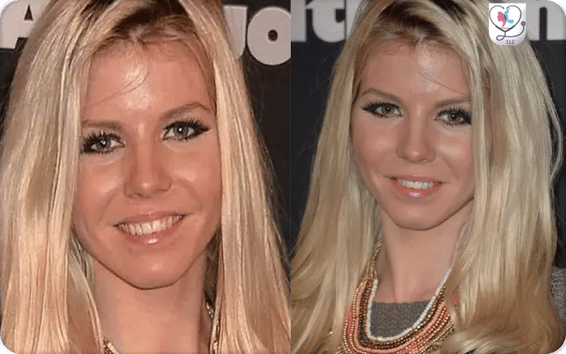 Jessica Thivenin avant la chirurgie