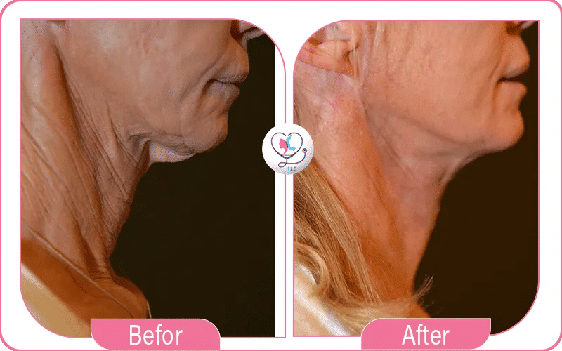 Nefertiti Neck Lift Before & After Photos: What to Expect image 1772044334746