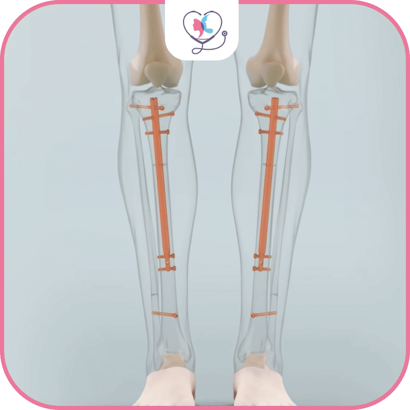 كيف تتم عملية زيادة الطول