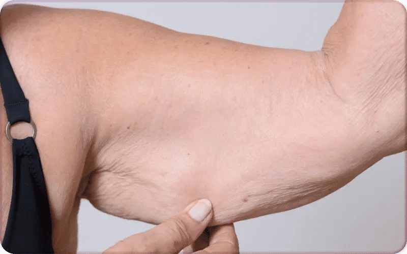 How to Tighten Loose Arm Skin After Weight Loss