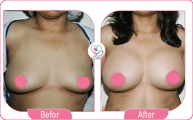 شد الثدي بالليزر