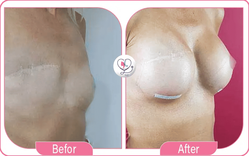 Reconstruction mammaire après mastectomie résultat