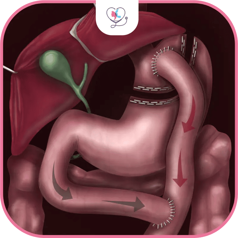 Pourquoi le bypass entraîne-t-il des carences en vitamines ?