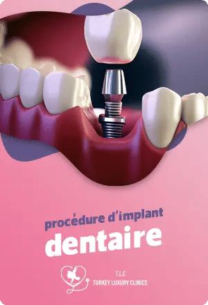 La procédure d'implant dentaire: étape par étapefeatured image