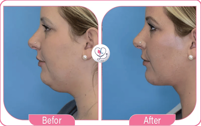 Mini Neck Lift Before and After Photos