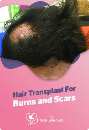 Hair Transplant For Burns and Scarsfeatured image