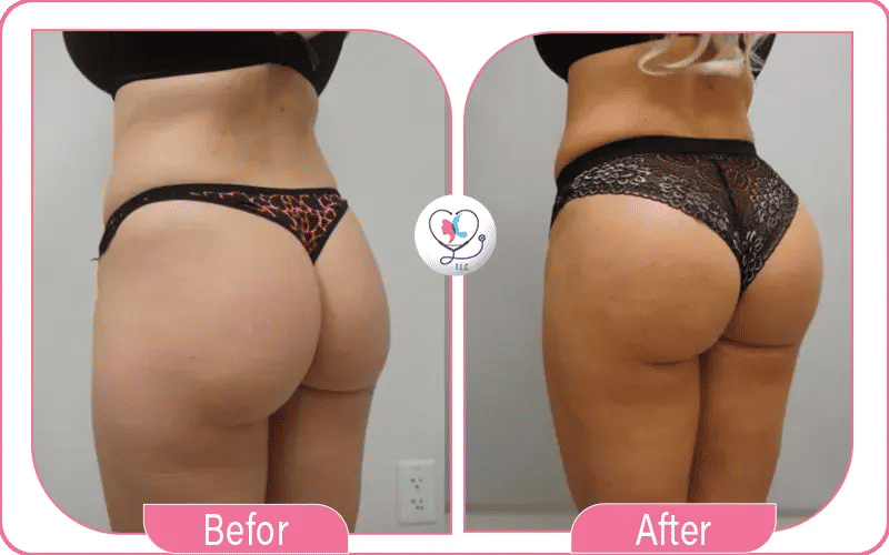 تجربتي الناجحة في تكبير المؤخرة - لونا من المغرب (40 سنة)