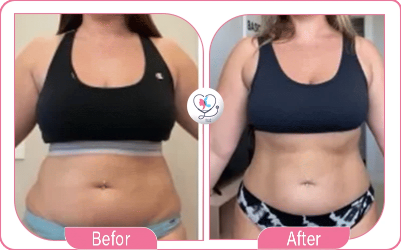 مراحل تجربتي مع عملية نحت الجسم