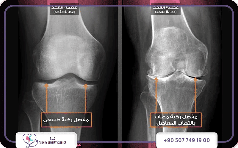 الفرق بين خشونة الركبة في الأشعة والرنين الفرق بين خشونة الركبة في الأشعة والرنين