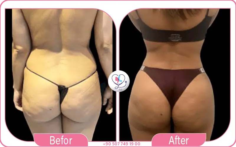 Best Hospitals for BBL Turkey Luxury Clinics