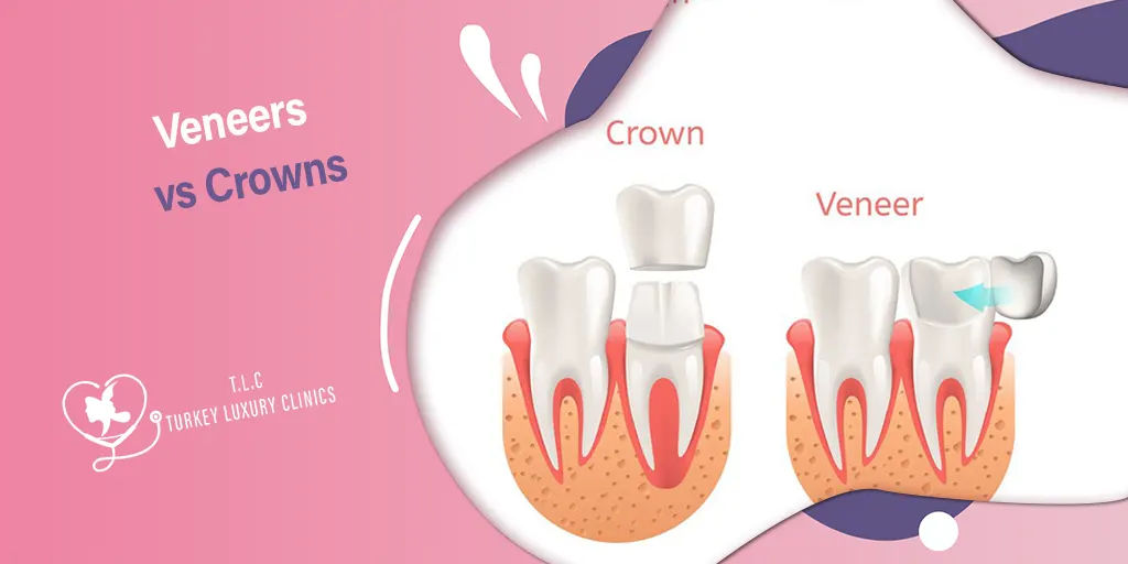 Veneers vs Crowns: Aesthetic, Durability, Uses and Costs