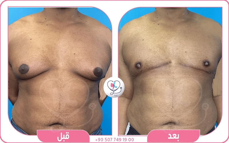 خطوات عملية شفط دهون الثدي للرجال