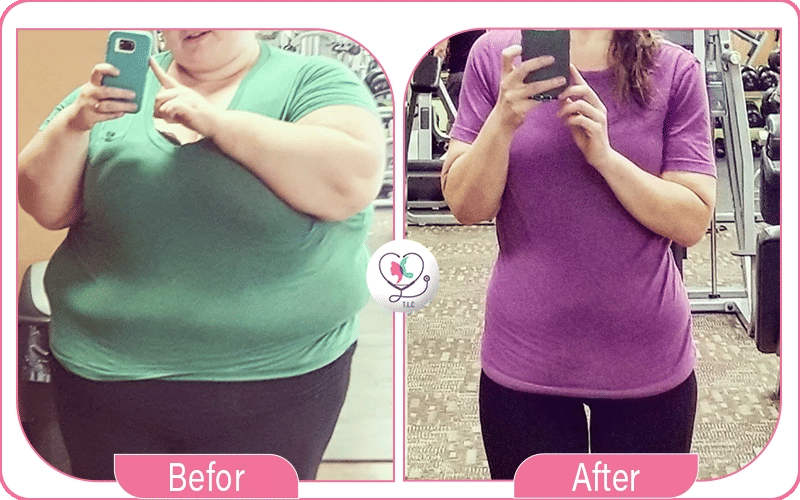 مراحل إجراء تجربتي مع بالون المعدة