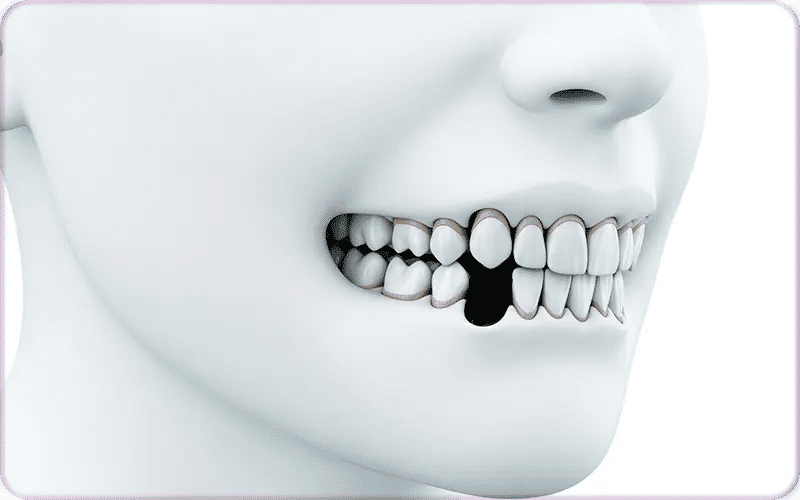 Quelles sont les conséquences d'une dent manquante ?