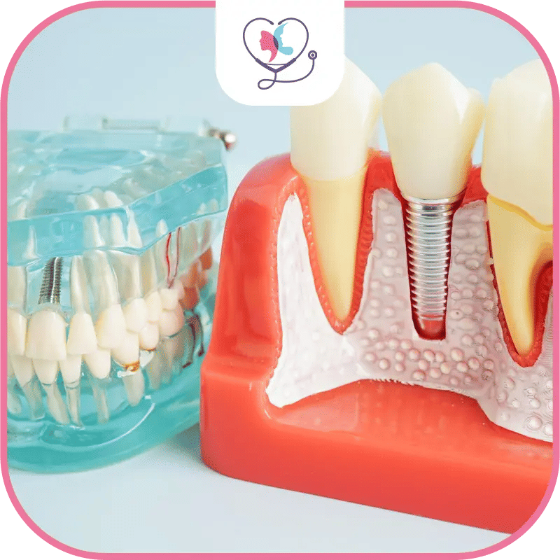 Âge convenable aux implants dentaires