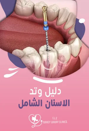 وتد الاسنان: دليل شامل الأنواع، وطربقة التركيب، والأسعار 2026