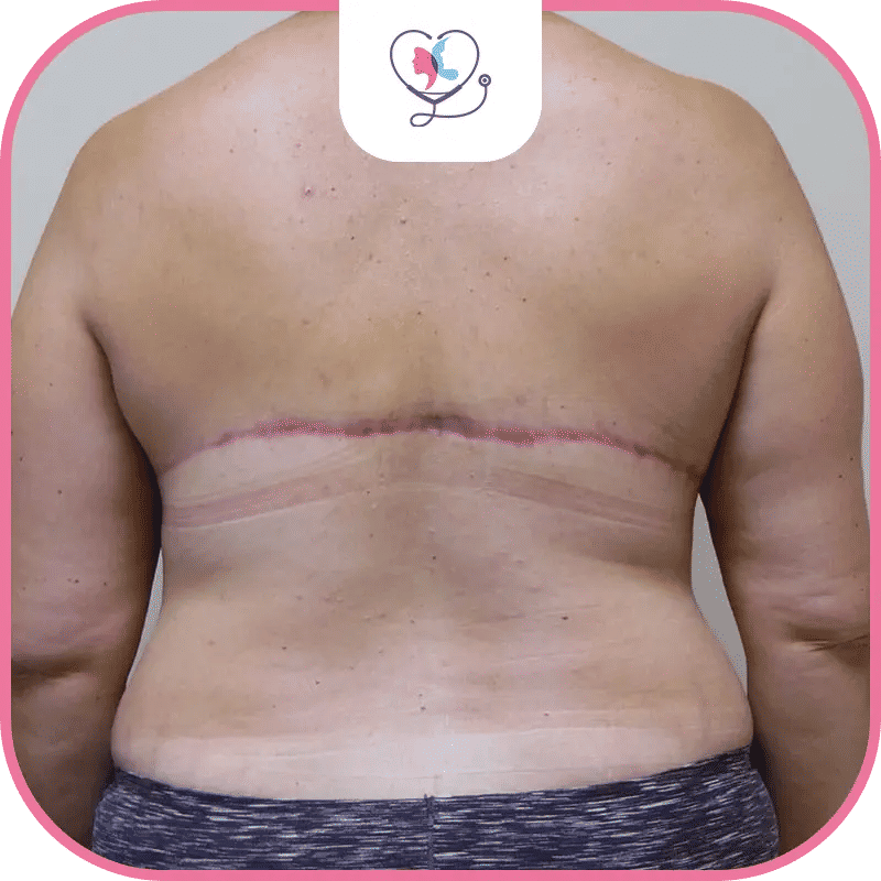 الندبات بعد عملية شد الظهر