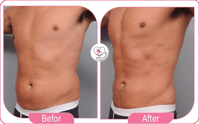 ما قبل إجراء عملية شفط الدهون 