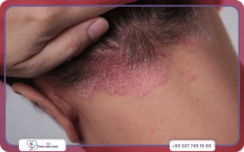 ما هي أنواع صدفية الرأس؟