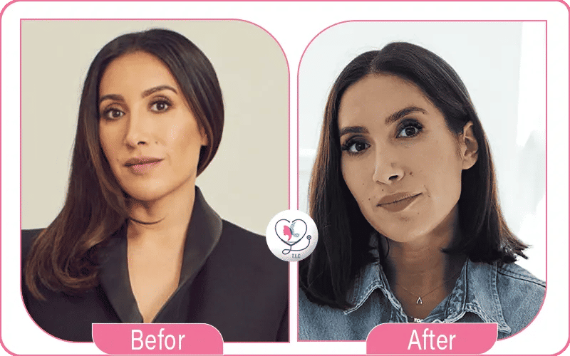 Before and After Eyebrow Transplant Celebrity 3