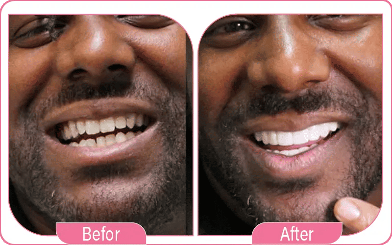 Porcelain Veneers in Turkey Before & After 3