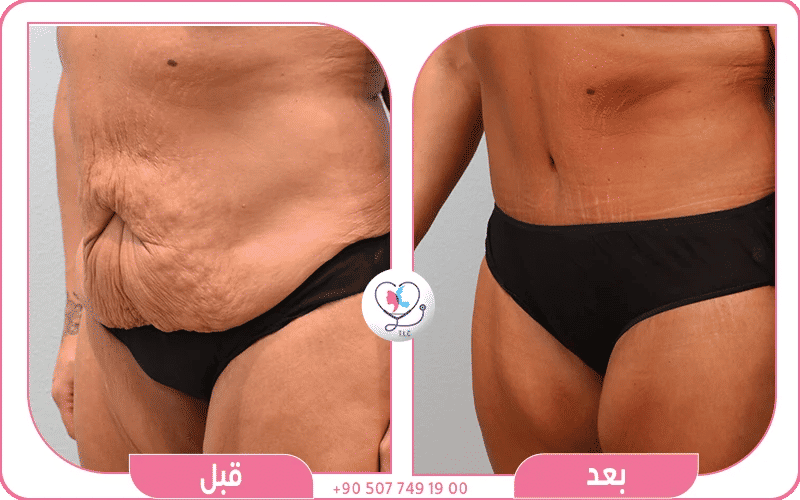 نتائج عمليات شد البطن