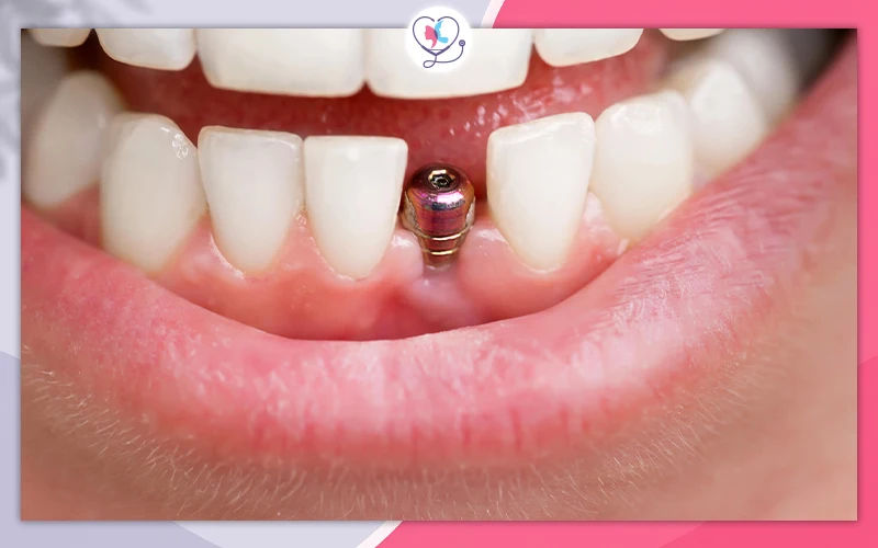 Dental Implants for Diabetics with Bone Loss