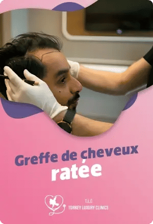 Greffe de cheveux ratée