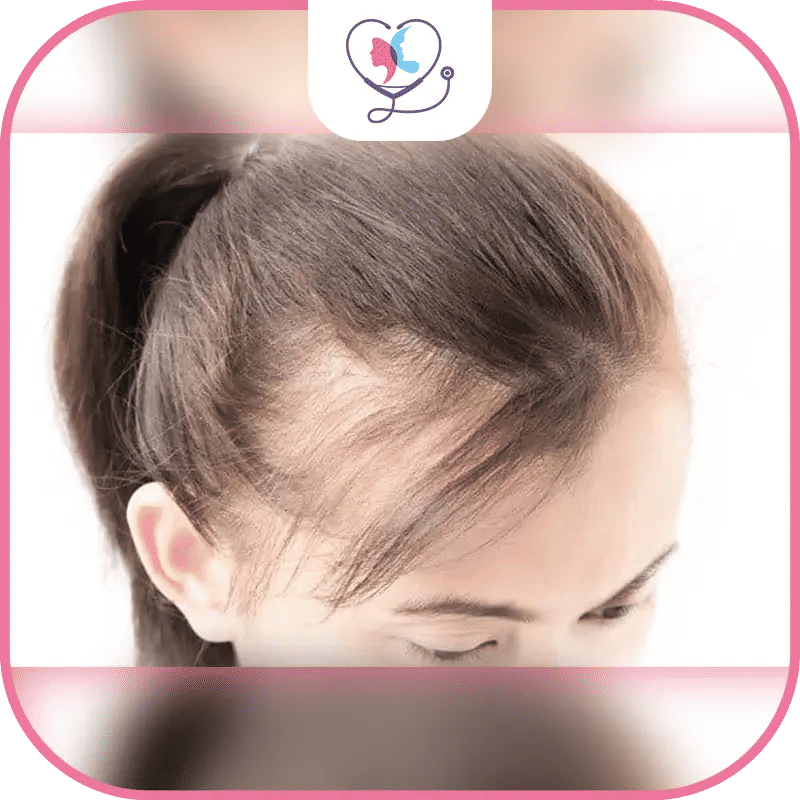 المرشحون للعلاج بجلسات فيلر الشعر