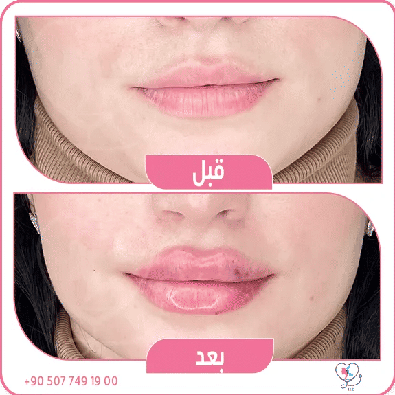 الشفايف الروسيه