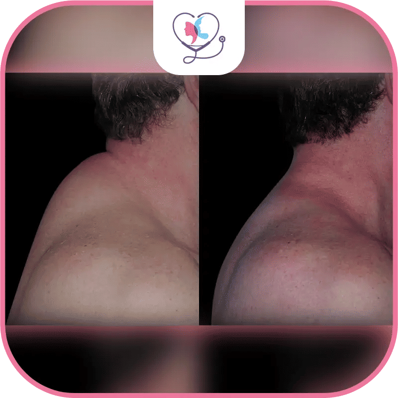 liposuccion bosse de bison - liposuccion bosse de bison avant après