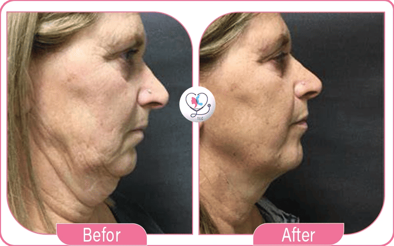 12. Chin/Neck (Optional Depending on Patient): Lipo 360 Results