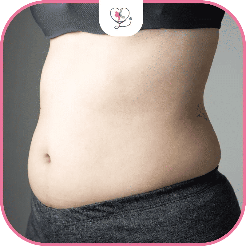 شفط الدهون بالليزر في تركيا