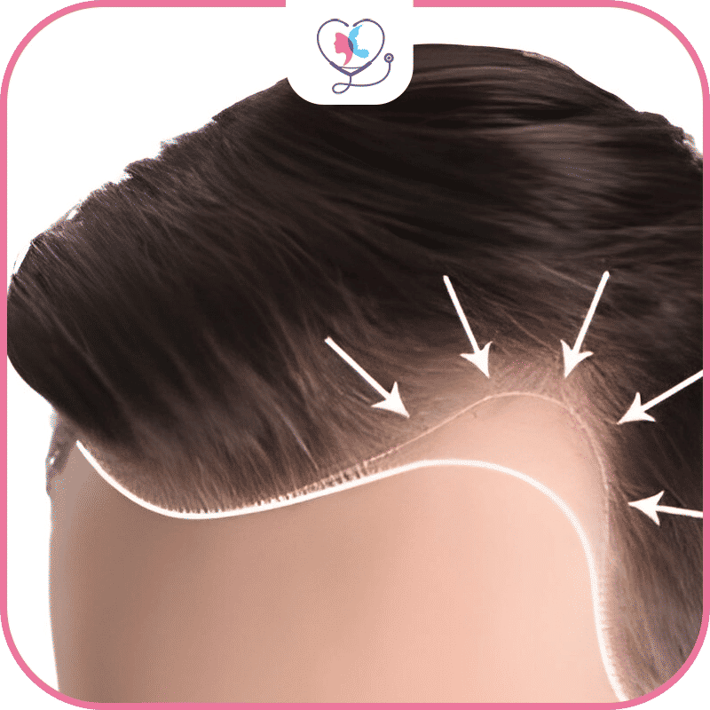 Overview About Hair Transplant
