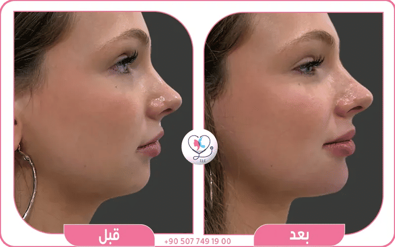 حقن الفلر قبل وبعد