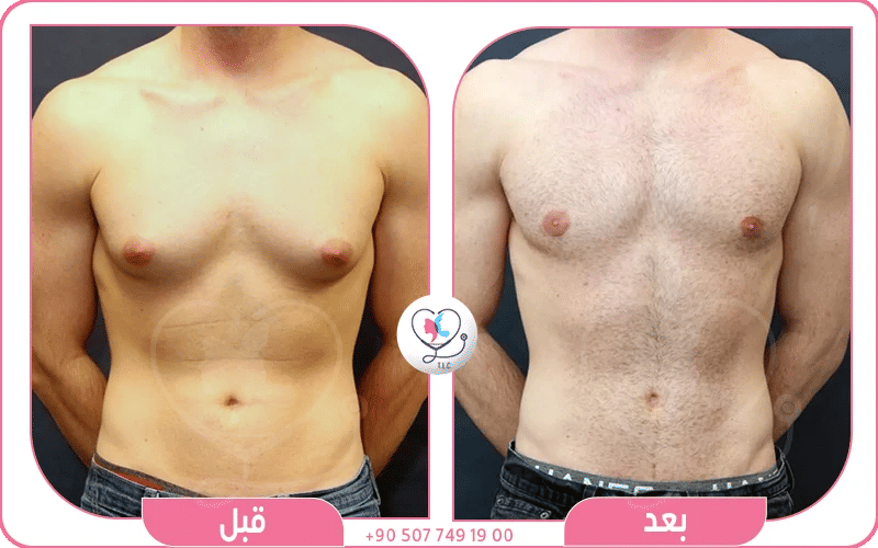 المرشحون لعملية شفط دهون الثدي للرجال