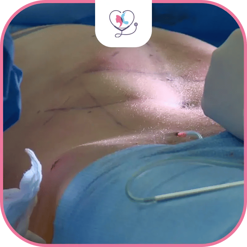 خطوات عملية نحت عضلات البطن