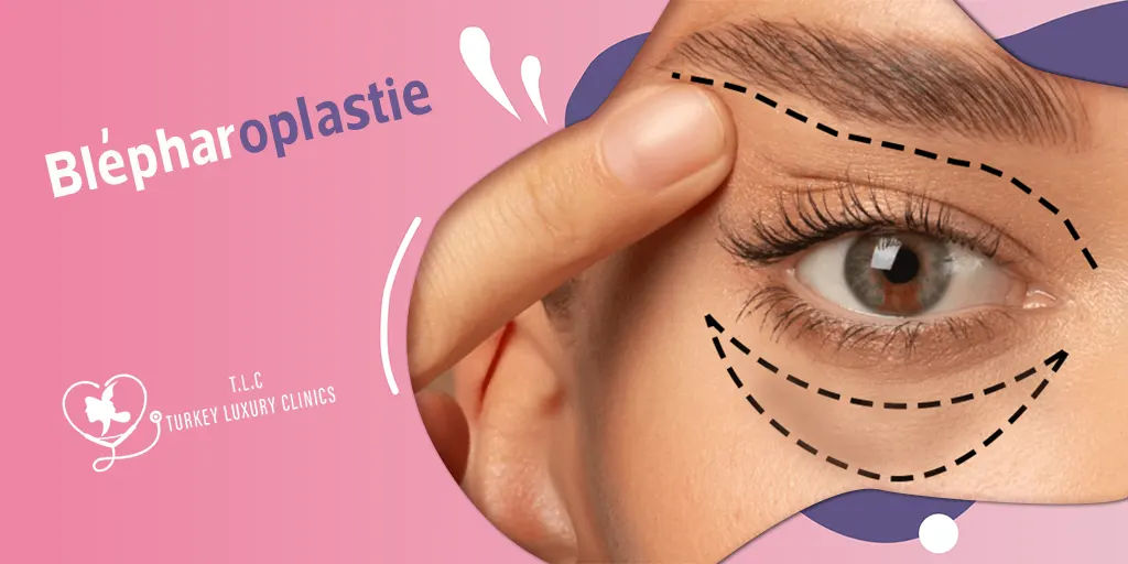 Blépharoplastie : tout savoir sur la chirurgie des paupières