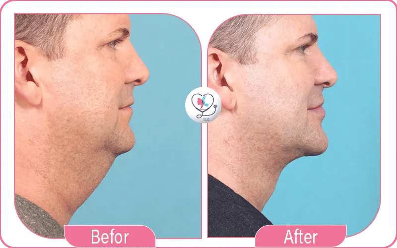 Transform Your Chin and Jawline with Affordable, High Quality Care