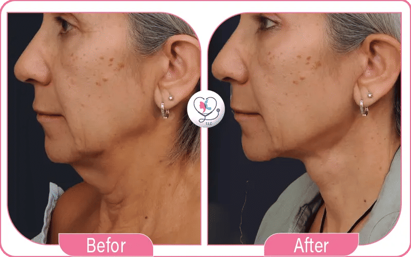Neck Lift in Turkey Before and After Photos 2