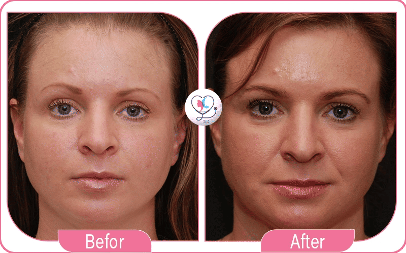 lipofilling visage avant et après-2