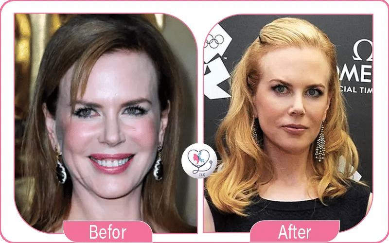 Suspected Nicole Kidman Cosmetic Surgery 3