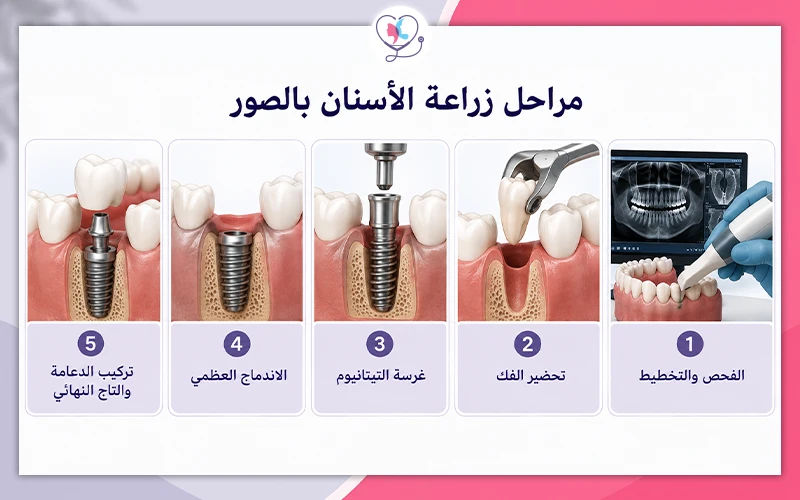 مراحل زراعة الأسنان بالصور