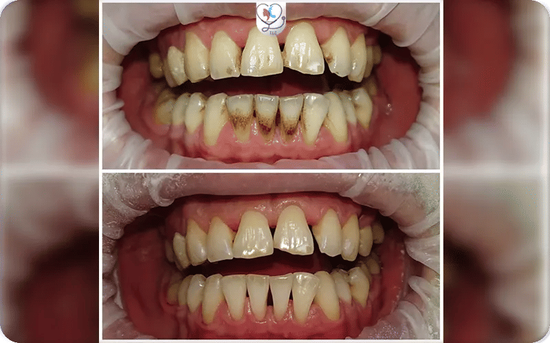 إزالة جير الأسنان تجربتي في تركيا لاكشري كلينك