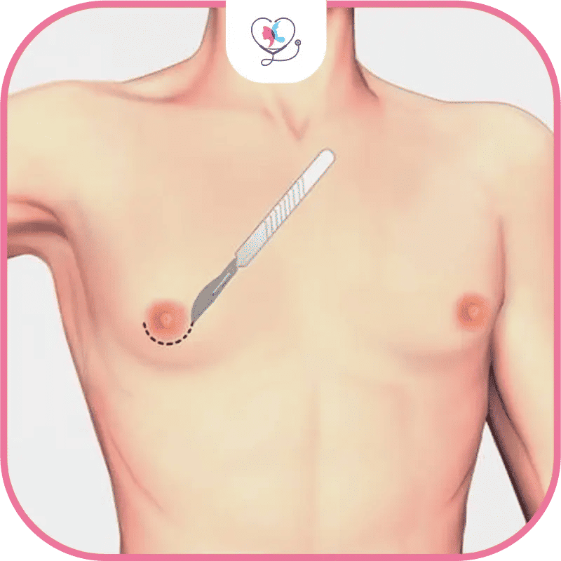 عيوب عملية التثدي عند الرجال